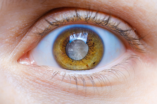 "An eye with the cataract disease"