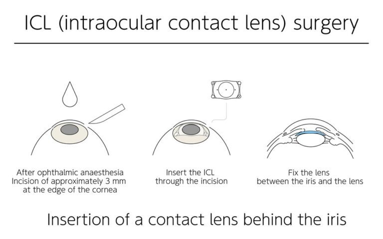 ICL-intraocular-contact-lens